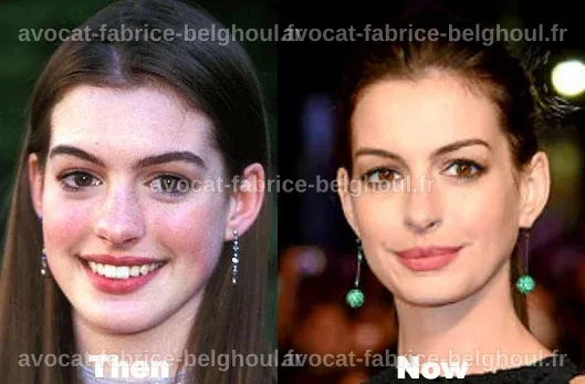 Anne Hathaway Chirurgie : Beauté ou Transformation ?