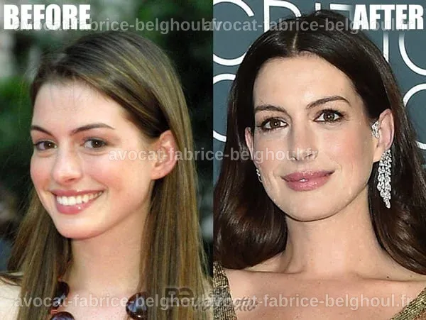 Évolution de l'apparence d'Anne Hathaway avec des photos avant et après la chirurgie.
