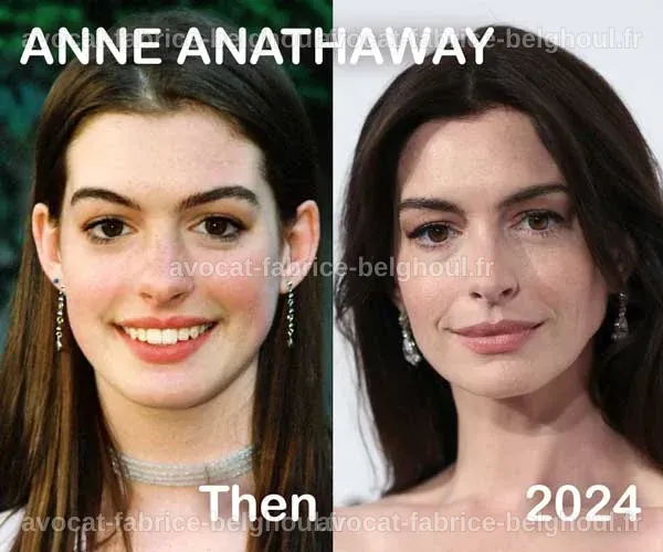 Exemples de célébrités ayant subi une rhinoplastie, montrant leurs transformations.