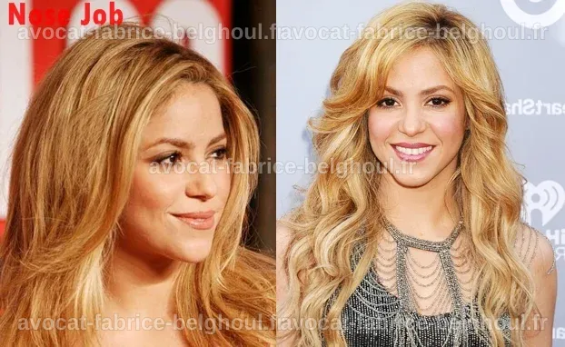 Shakira Chirurgie : Sa Transformation Étonnante