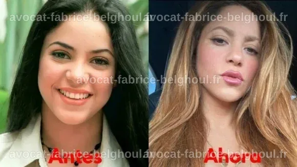Comparaison avant et après des interventions esthétiques de Shakira.